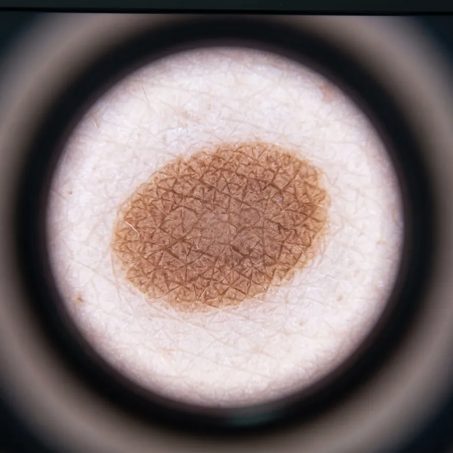 A dermoscopic close-up of a mole showing its pigment network